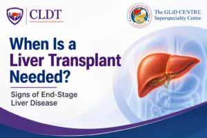Liver transplant evaluation and signs of end-stage liver disease