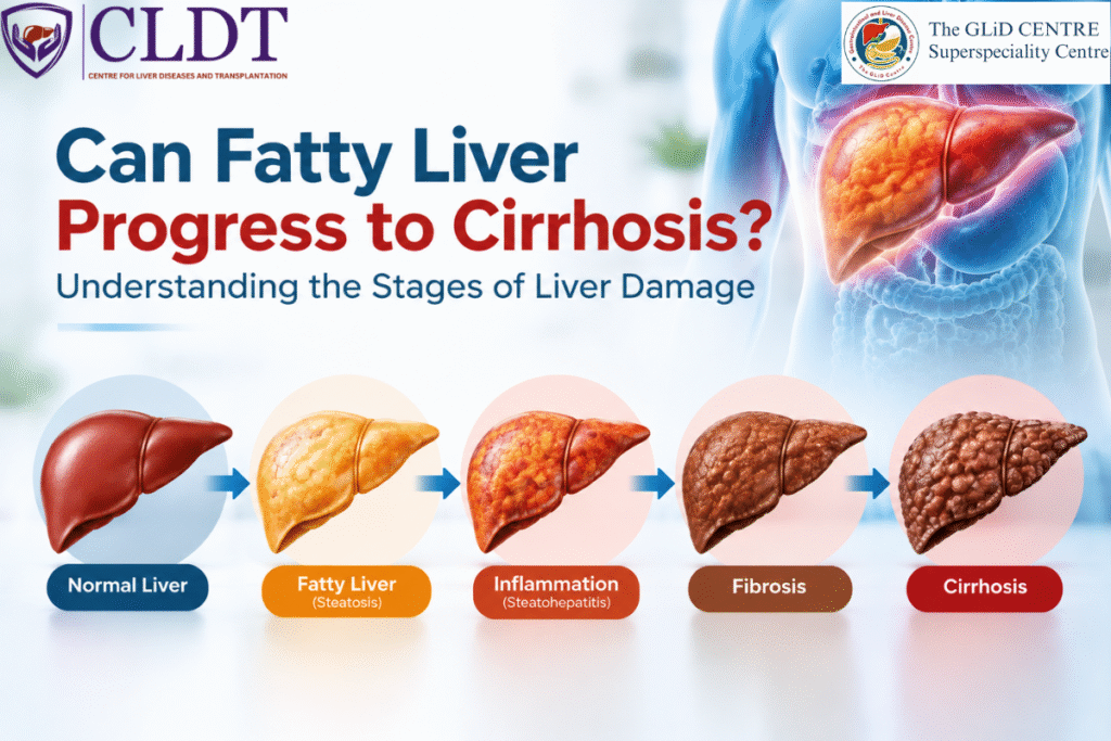 Stages of fatty liver progression from steatosis to cirrhosis