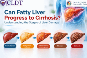 Stages of fatty liver progression from steatosis to cirrhosis