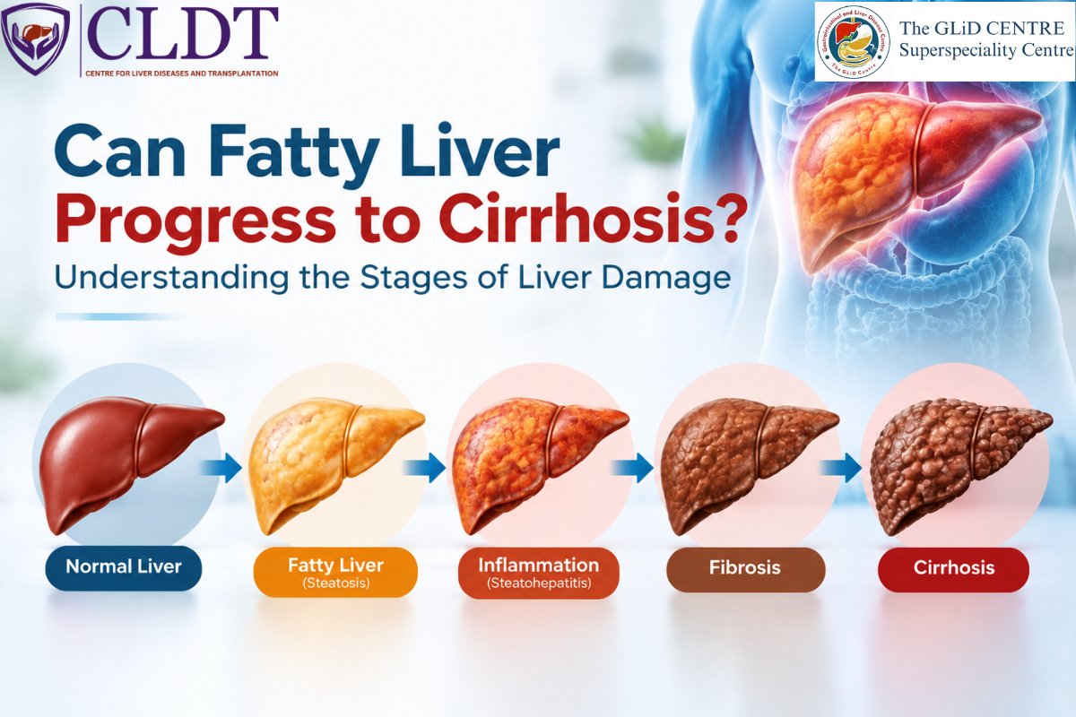 Stages of fatty liver progression from steatosis to cirrhosis